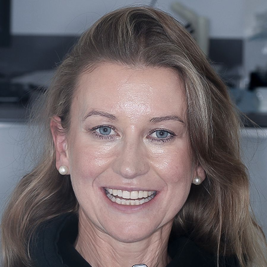 composite bonding-after - Carmen - 3dental